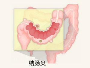 泉州结肠炎治疗的方法哪种好