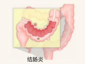 泉州医博治疗结肠炎什么方法好